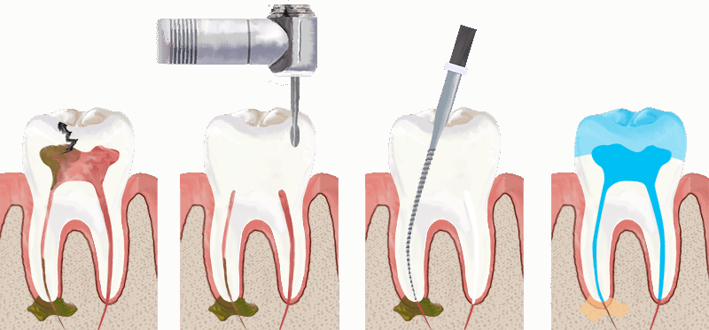 Endodontics Khandpur