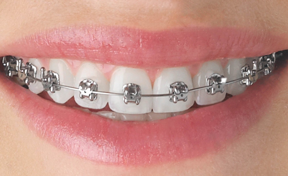 Orthodontics Khandpur Dental